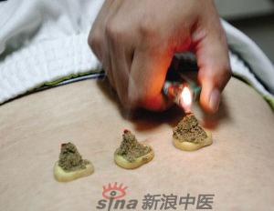 灸法的種類  你知道多少？